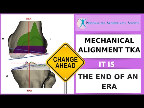Mechanical Alignment for Total Knee Arthroplasty,  It is the End of an Era