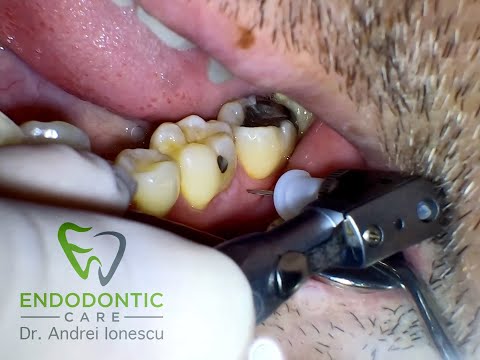 Intraosseous Anaesthesia - (X tip) - Dr. Andrei Ionescu