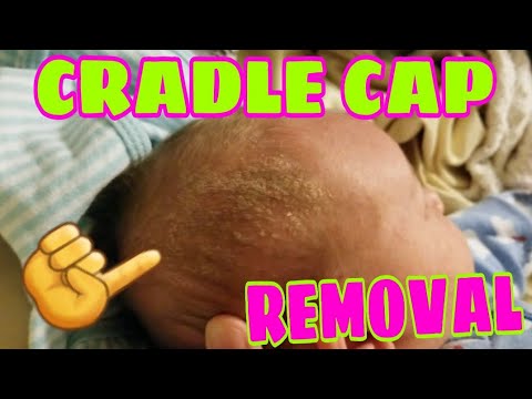 SUPER EASY AND NATURAL WAY TO REMOVE CRADLE CAP - YouTube