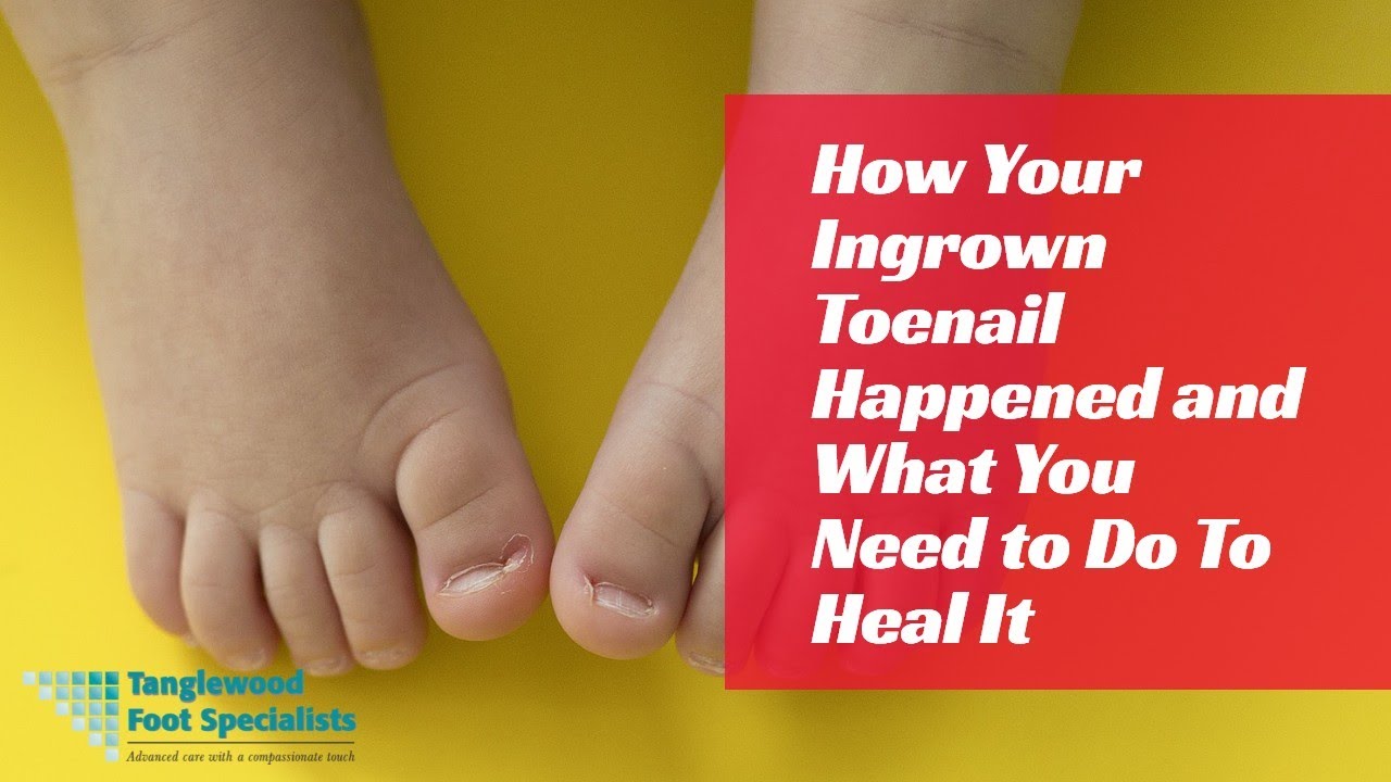 How Your Ingrown Toenail Happened and What You Need to Do To Heal It
