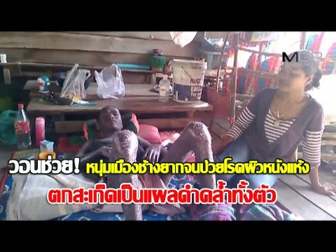 การรักษาทะเลเดดซีของโรคสะเก็ดเงิน ภาพกลากในร่างกายทั้งหมด