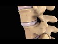 Back Pain: Lumbar Disc Injury