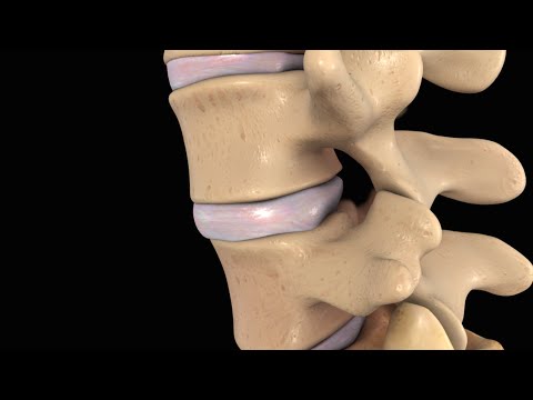 Parte bassa della schiena Crociata dolori lombari Trattamento osteocondrosi cardialgia