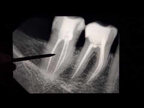Диагностика периодонтита. Киста зуба на томографии. Одонтогенный гайморит. Гранулёма зуба