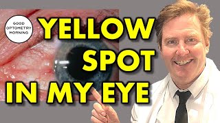 YELLOW SPOT IN EYE: Pinguecula treatment from Youtube Eye Doctor & Optometrist