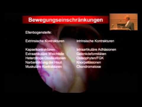 Nicht in den Gelenken OMC enthalten Die Behandlung der Volksheilmittel für Bursitis des Kniegelenks