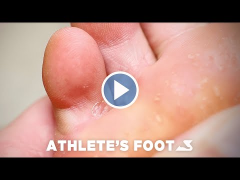 How To Treat Athlete's Foot - BioPed Footcare