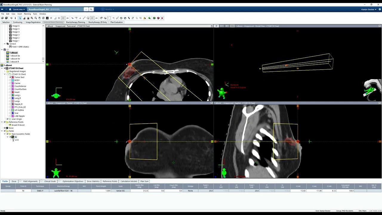Planning an Electron Boost for a Tumor Bed