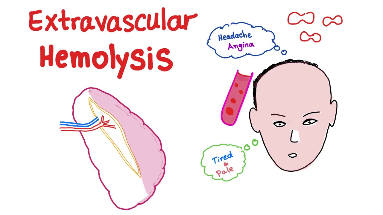 Extravascular Hemolysis