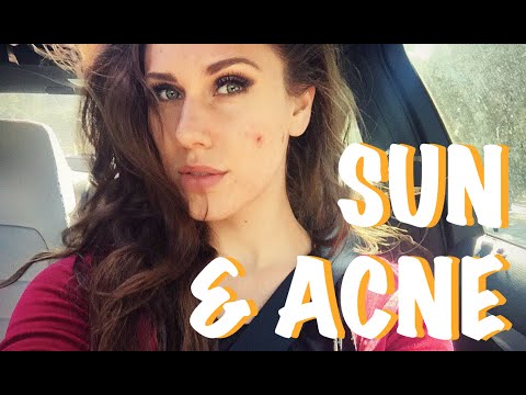 Is Sun Good Or Bad For Acne? | Cassandra Bankson Video