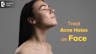 Top Ways to Get Rid of ACNE HOLES | How to fill ACNE HOLES on face?-Dr. Rasya Dixit| Doctors