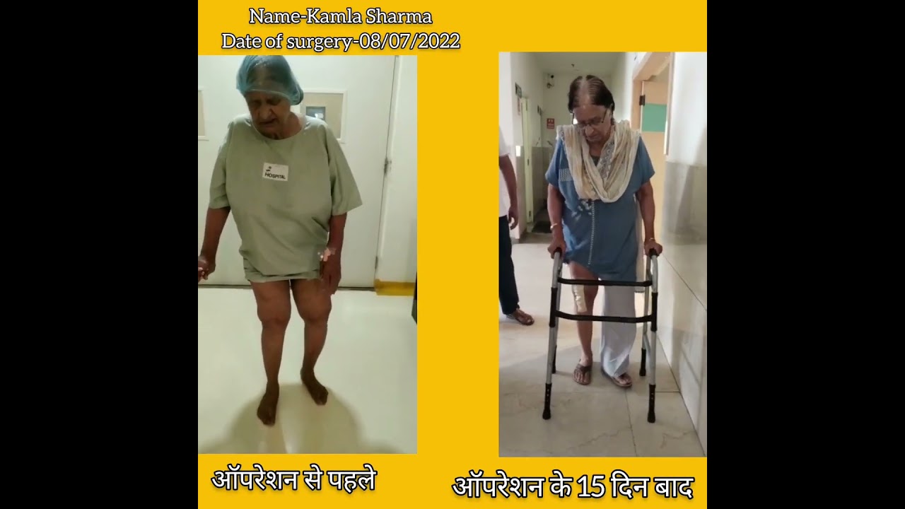 Knee Replacement Surgery - pt name Kamla Sharma #kneepain #kneereplacementsurgery #drtarunsolanki