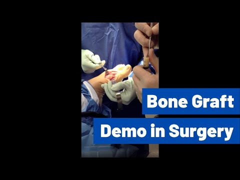 Cosmetic Toe Shortening Long Toe Surgery Video Without Metal Pins