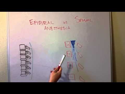 Epidural vs Spinal Anesthesia