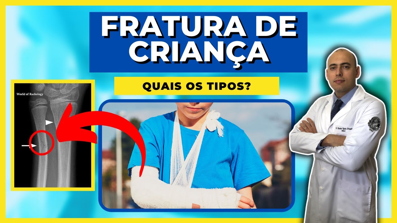 FRATURA DE CRIANÇA | SAIBA QUAIS SÃO OS TIPOS E QUAL O TRATAMENTO INDICADO!