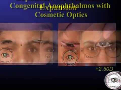 Custom Artificial Eyes: India By Dr Kuldeep Raizada, Ph D, BCO, BADO