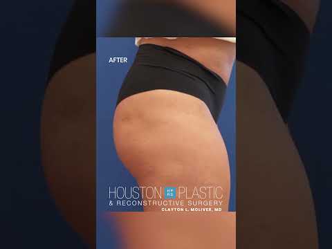 Depression on the buttocks surface caused by steroid shot #renuvatreatment #plasticsurgeon