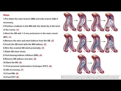9- DK Crush Technique - Dr. Sherif Rizk