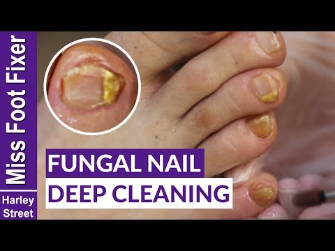 Kuko fungal sakit at paggamot nito Paggamot ng fungal kuko sa paa gamot
