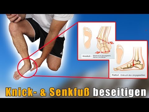 Fix flat feet and fallen arches in 3 effective steps (+ no more insoles)