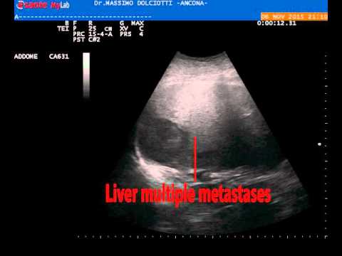Laspettativa per il grado 3 il cancro alla prostata Nessun urine per adenoma prostatico