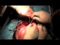 Видео перелома ключицы - Травматология и ортопедия - Видео хирургии и операций 