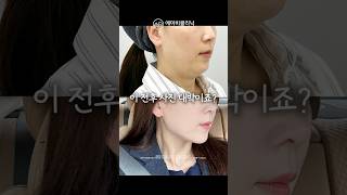 울쎄라 효과 간접 체험하기 ⚡