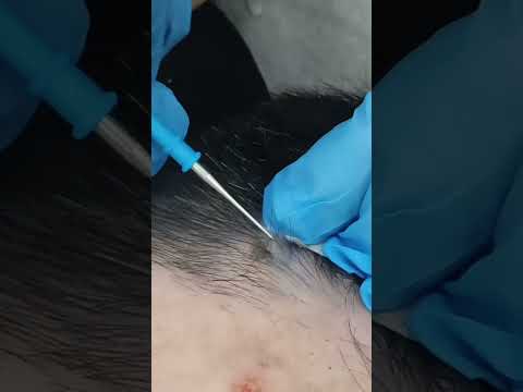 Safe Laser Mole & Skin Tag Removal | Real Patient Transformations