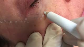 Removing Dark Blue Veins Under the Eyes [Under Eye Treatment That