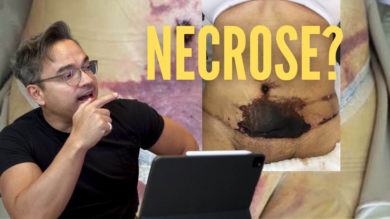 COMPLICAÇÕES DA ABDOMINOPLASTIA, POSSO MORR#R?