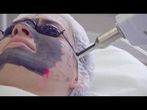 Carbon Laser Peel at Prima Britannia Laser Clinic