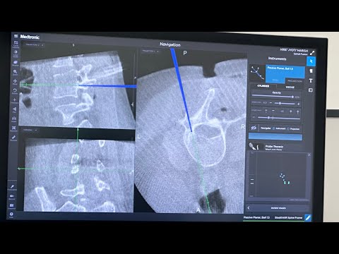 Endoscopic TLIF Spine surgery : Dr. Ajay Kothari