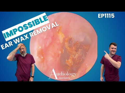 EXTREME Ear Wax Removal! Rock Hard Plug Stuck Deep 👂😱 - EP1115