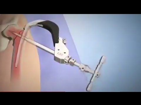Intramedullary fixation using the TFN-Advanced (TFNA) proximal femoral nailing system