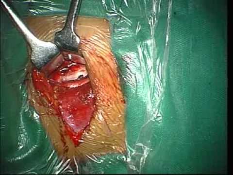 Anterior zervikale Diskektomie und Fusion von C5 und C6 Wirbel