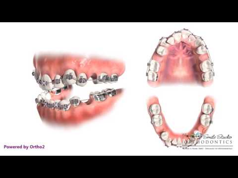 4 Second Bicuspid Extraction - Orthodontic Treatment