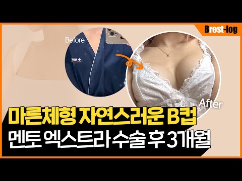 AAA컵이 가슴 수술을 하면? | 제니가슴 자연스러운 B컵된 후기 | 가슴확대수술 | 윈느성형외과 | 윈느성형외과 라벨윈느 유튜브 영상