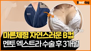 AAA컵이 가슴 수술을 하면? | 제니가슴 자연스러운 B컵된 후기 | 가슴확대수술 | 윈느성형외과