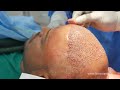 Hair Transplant Surgery In India Step By Step FUE Hair Transplant Surgery In India 4000 Grafts