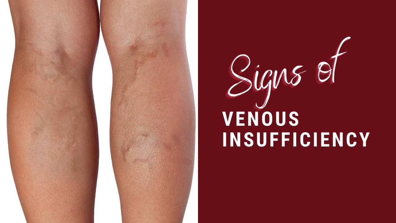 Signs and Symptoms of Venous Insufficiency