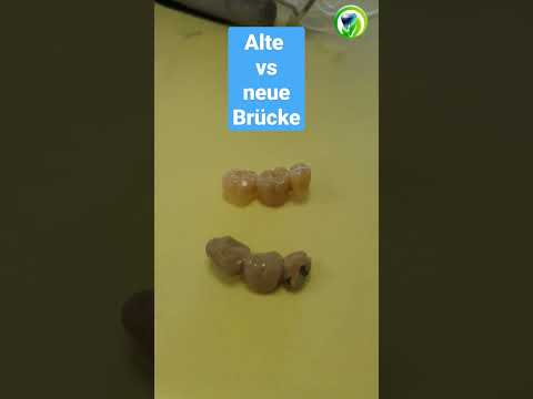 Alte vs neue Brücke - VMK-Brücke - Zirkonbrücke - Vollkeramik #zahnarzt #zahnmedizin #festezähne