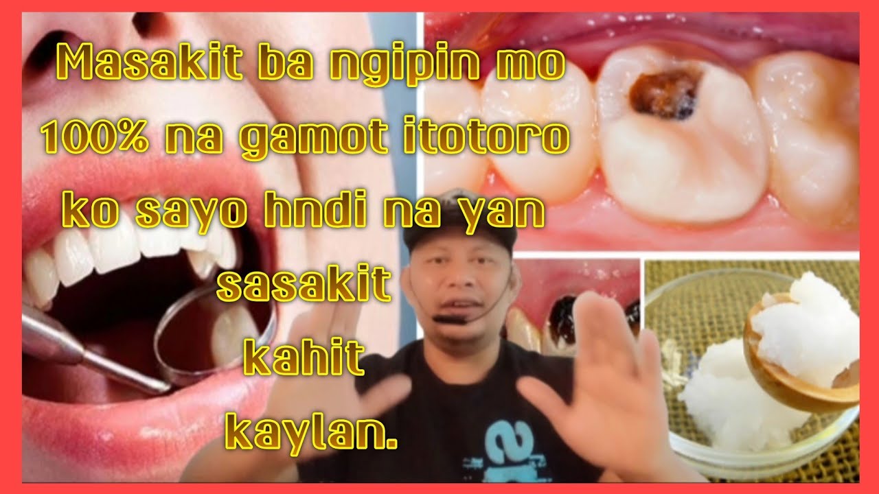 Putar video paano gamotin ang pinaka masakit na ngipin na my butas 100%itotoro ko sayo hndi na sasakit ngipin mo sekarang paano gamotin ang pinaka masakit na ngipin na my butas 100%itotoro ko sayo hndi na sasakit ngipin mo