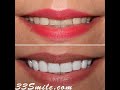 Cosmetic Dentistry Prepless Dental Veneers Before and After.