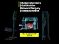 cholecystectomy gallbladder removal surgery nucleus health II youtube shortsII #2 II 3d avtar II