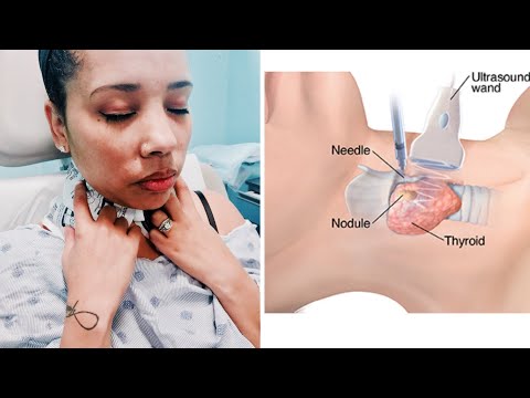 My Thyroid Biopsy Experience