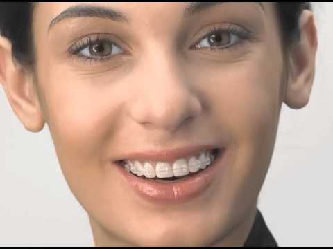 Clear Braces Video