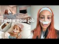 I got a NOSE JOB IN TURKEY! What to expect, surgery day, bag prep, pain, cost, why I did it (pt. 1)