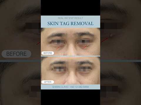 Quick & Safe Skin Tag Removal | Eyelid & Body Laser Treatment