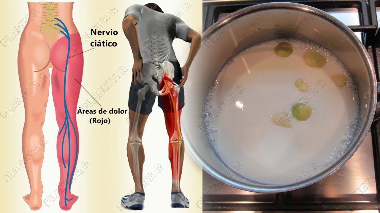 dolor extremo nervio ciatico