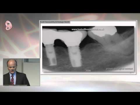 Peter Briggs Endodontics or Implants